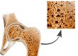 osteoporosis in femur bone, human bone anatomy