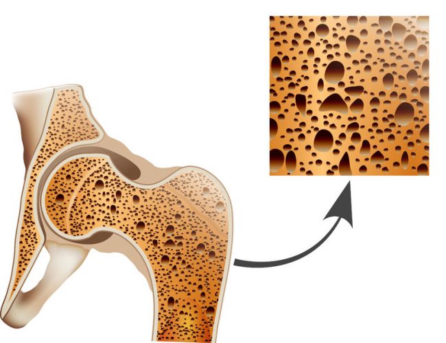 osteoporosis in femur bone, human bone anatomy